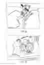 Fig. 05 - Intubation with audiovibratory guidance