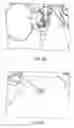 Fig. 06 - Intubation with audiovibratory guidance