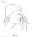 Fig. 11 - METHODS FOR TREATING RHINITIS AND CONJUNCTIVITIS