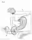 Fig. 03 - NERVE STIMULATION AND BLOCKING FOR TREATMENT OF GASTROINTESTINAL DISORDERS
