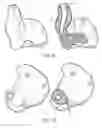 Fig. 09 - Custom elastomeric earmold with secondary material infusion