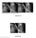 Fig. 08 - METHOD AND SYSTEM FOR PROCESSING AN IMAGE FRAME SHOWING A BIODEGRADABLE MEDICAL DEVICE IN A PART OF A HUMAN BODY