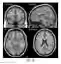 Fig. 35 - Systems and methods for generating biomarkers based on multivariate classification of functional imaging and associated data