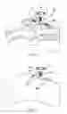 Fig. 15 - Intraosseous device
