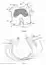 Fig. 04 - Resilient interpositional arthroplasty device