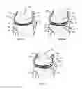 Fig. 07 - Resilient interpositional arthroplasty device