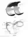 Fig. 14 - Resilient interpositional arthroplasty device