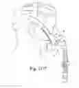 Fig. 71 - DELIVERY OF RESPIRATORY THERAPY