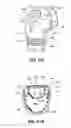 Fig. 25 - Mask assembly with cushion-receiving channel and partial bead therein