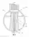 Fig. 07 - Method and apparatus for removing microvessels