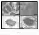 Fig. 16 - METHODS AND COMPOSITIONS PERTAINING TO HUMAN CEREBRAL CAVERNOUS MALFORMATIONS
