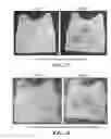Fig. 20 - Soft ballistic resistant armor