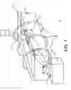 Fig. 02 - Hyperthermic cancerous tissue ablation