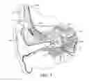 Fig. 02 - Template for bilateral symmetric stimulator fixation/implantation