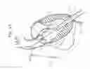Fig. 04 - Systems of heart valve delivery on a beating heart