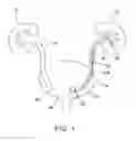 Fig. 02 - Ureteral stent for placement in a kidney and bladder