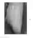 Fig. 02 - OSTEOINDUCTIVE FIBROUS BONE CHIPS
