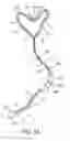 Fig. 03 - Detecting combustion of a nasal cannula