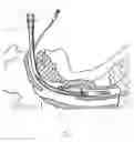 Fig. 02 - Smart ETT ventilation attachment and method of use