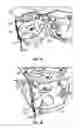 Fig. 05 - Boat apparatus for producing a surf wake