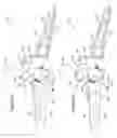 Fig. 95 - Single hand operated collapsing hanger
