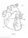 Fig. 02 - METHODS AND APPARATUS FOR TRANSPERICARDIAL LEFT ATRIAL APPENDAGE CLOSURE