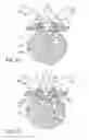 Fig. 16 - Systems and methods for removing a tissue specimen or organ through a small incision or natural opening in a patient