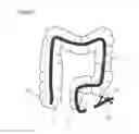 Fig. 07 - Percutaneous Gastrointestinal Access System and Method