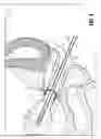 Fig. 06 - UTERINE MANIPULATOR