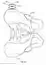 Fig. 09 - PATIENT-SPECIFIC PROSTHESIS ALIGNMENT