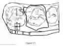 Fig. 09 - METHOD FOR FACILITATING A TOOTH REPOSITIONING DENTAL TREATMENT