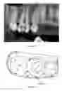 Fig. 12 - METHOD FOR FACILITATING A TOOTH REPOSITIONING DENTAL TREATMENT