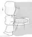 Fig. 07 - Overload failure reducing dental implants
