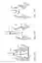 Fig. 71 - PROFILE REDUCTION OF VALVE IMPLANT