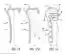 Fig. 09 - Bone joint replacement and repair assembly and method of repairing and replacing a bone joint