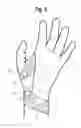 Fig. 07 - DEVICES TO BE USED FOR ACUPRESSURE