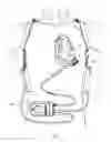 Fig. 02 - Systems for LVAD operation during communication losses