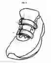 Fig. 03 - Shoe fastening system