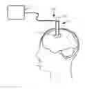 Fig. 01 - Cannula with proximally mounted camera