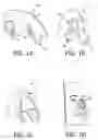 Fig. 02 - FIXATION METHOD FOR A NASAL SEPTUM SENSOR FOR MEASURING MEDICAL PARAMETERS