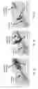 Fig. 06 - Vascular closure device