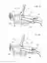 Fig. 07 - Guidance system mounts for surgical introducers