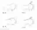 Fig. 02 - INSTRUMENTS FOR USE IN FEMOROACETABULAR IMPINGEMENT PROCEDURES