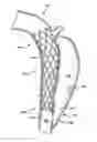 Fig. 01 - Method and apparatus for substantially blocking bloodflow through a dissected aorta
