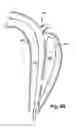 Fig. 06 - Method and apparatus for substantially blocking bloodflow through a dissected aorta