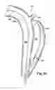 Fig. 07 - Method and apparatus for substantially blocking bloodflow through a dissected aorta