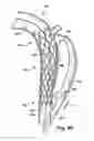Fig. 08 - Method and apparatus for substantially blocking bloodflow through a dissected aorta