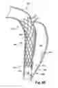 Fig. 09 - Method and apparatus for substantially blocking bloodflow through a dissected aorta