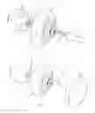 Fig. 02 - PYLORIC OBSTRUCTION DEVICE WITH SPACE-OCCUPYING DEVICE