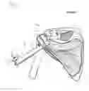 Fig. 08 - Method of Humeral Head Resurfacing and/or Replacement and System for Accomplishing the Method